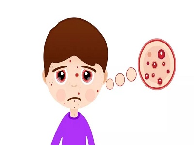 脸上牛皮癣应该如何治疗