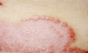 孩子得了牛皮癣注意什么