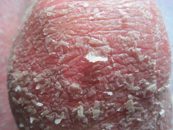 银屑病为啥会脱屑