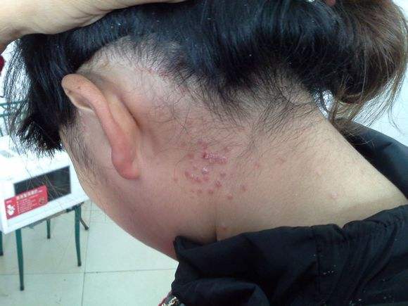 牛皮癣患病原因