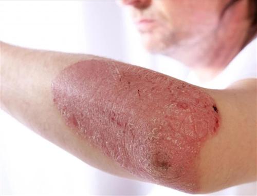 广州看牛皮癣的医院