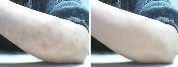 广州牛皮癣人群需要注意的治疗事项