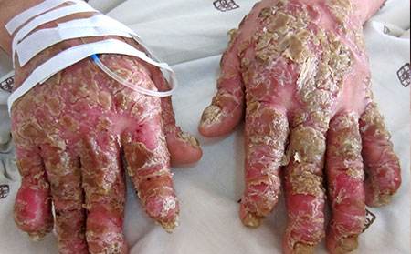 牛皮癣还能治好吗